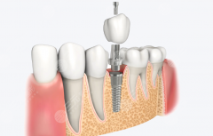 唐山牙博士口腔医院种植牙怎么样？多少钱？医院实力和价格一文读懂