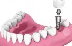 苏州好牙引领口腔种植牙怎么样？多少钱？种牙体验和价格情况都在这