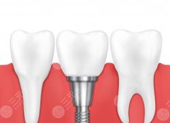 大连医大一院假体隆鼻怎么样？公立项目口碑和风格特点一文了解