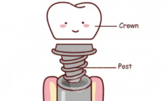 江门市港湾侨邑口腔种植牙怎么样？多少钱？从缺牙修复需求出发，看它家种牙到底有何亮点