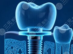 武汉晴川立康口腔种植牙怎么样？多少钱？种牙体验和价格区间整理好了