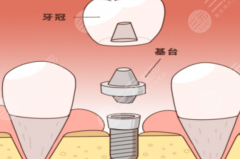 保定精卓口腔种植牙怎么样？多少钱？医生团队、设备配置、收费透明度全方位拆解