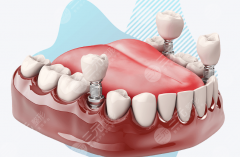 上海易美口腔种植牙怎么样？多少钱？价格高低只是表面，种植体品牌和修复方案才是真差距