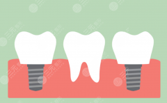 河南牙大夫口腔种植牙怎么样？多少钱？从口碑到费用给你做个详细参考