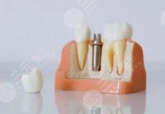 象山丹山口腔种植牙怎么样？多少钱？种植牙情况和价格明细，一次性讲清楚速看