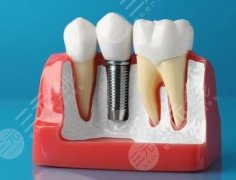 珠海九龙简牙口腔种植牙怎么样？多少钱？新价格明细一一揭晓