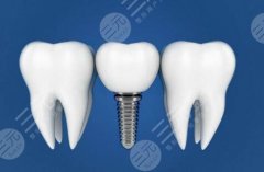 成都郫都包世洲口腔种植牙怎么样？多少钱？全解析：价格、资质、服务了解