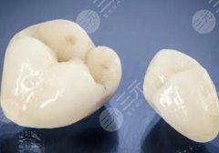 哈尔滨慧爱口腔种植牙怎么样？多少钱？冰城缺牙人必看的种牙全攻略