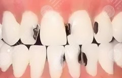 青岛大学附属医院割双眼皮多少钱？2026最新价目+避坑指南出炉