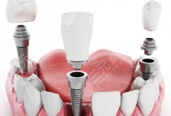 济南牙牙总动员口腔种植牙怎么样?多少钱?价格明细、服务细节全说透 济南牙牙总动员口腔种植牙怎么样?多少钱?价格明细、服务细节全说透