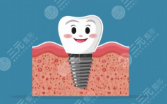 石家庄德尔口腔种植牙怎么样？多少钱？先看看口碑如何、费用多少再决定