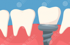 厦门登特口腔种植牙怎么样？多少钱？医院特色、医生水平和收费情况全盘点