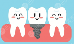 重庆牙博士口腔种植牙怎么样？多少钱？口碑、医生、收费情况一次给你讲清楚
