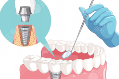 杭州美莱医疗美容(口腔)种植牙怎么样?多少钱?技术优势、品牌实力与价格参考全解析 杭州美莱医疗美容(口腔)种植牙怎么样?多少钱?技术优势、品牌实力与价格参考全解析
