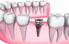 温岭东方医院口腔中心种植牙怎么样？多少钱？价格参考与口碑信息整理