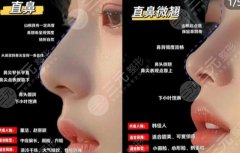 长治人民医院隆鼻价格贵不贵？2026全新价目表一览