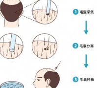 温州附二医植发技术怎么样？价格贵不贵？收费细节展示