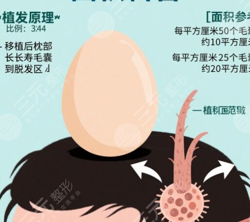 植发