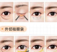 齐鲁医院眼袋切除术需要多少钱？价格表全新发布！透明收费更放心