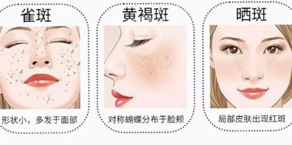祛斑