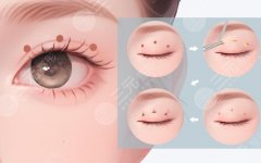 南通第一人民医院美容科哪位医生开双眼皮好？ 杨军|季建峰|周长凯技术靠谱