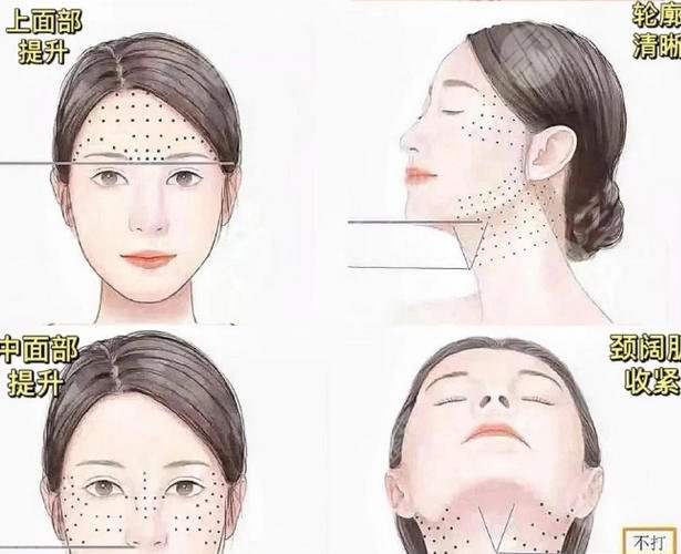 面部提升