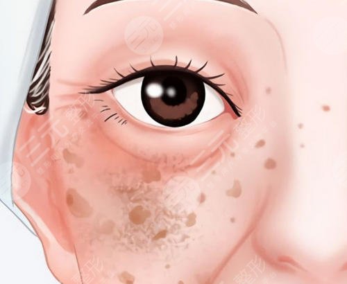 祛斑