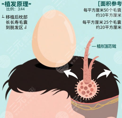 植发