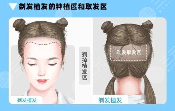 植发