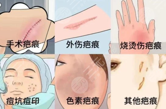 祛疤