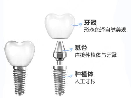 牙齿种植