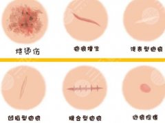 宁波大学附属医院祛疤专家名单一览！陈薇薇、胡文波技术靠谱！