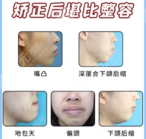 牙齿矫正