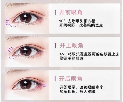 开眼角