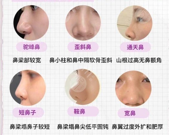 隆鼻