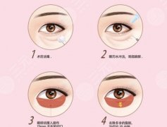 青医附院祛眼袋怎么样？医院技术优势、口碑评价来袭！