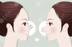 绍兴第二医院假体隆鼻多少钱？假体类型与价位差别，速看