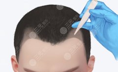 江西南昌植发哪个医院好？本地靠谱机构筛选与选择参考