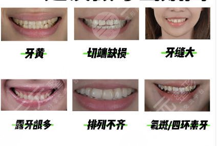 牙齿瓷贴面