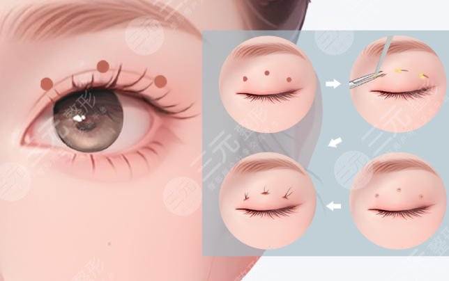 双眼皮
