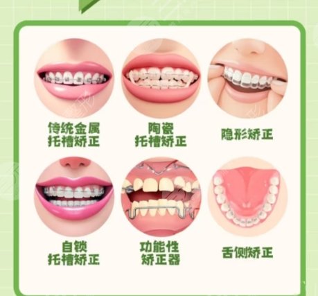 牙齿矫正