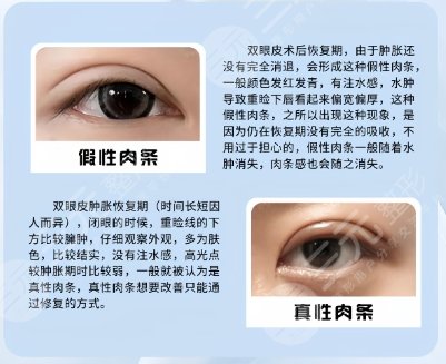双眼皮