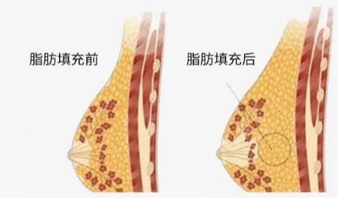 隆胸