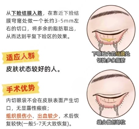 去眼袋