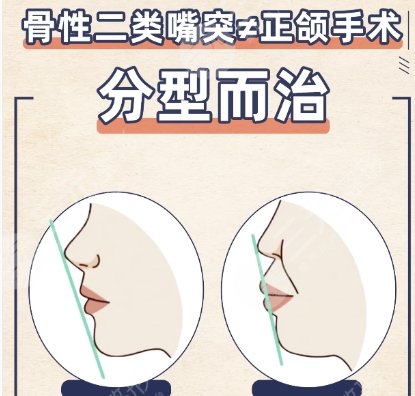 正颌