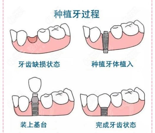 牙齿种植