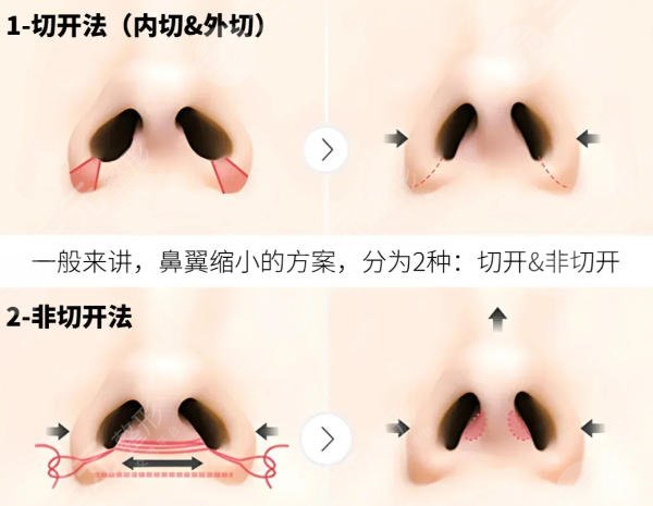 鼻翼缩小