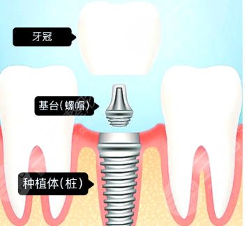 牙齿种植