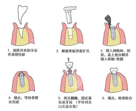 牙齿种植