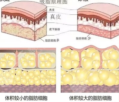 吸脂